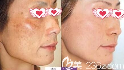 祛斑真人前后<span style= 祛斑真人前后<span style=
