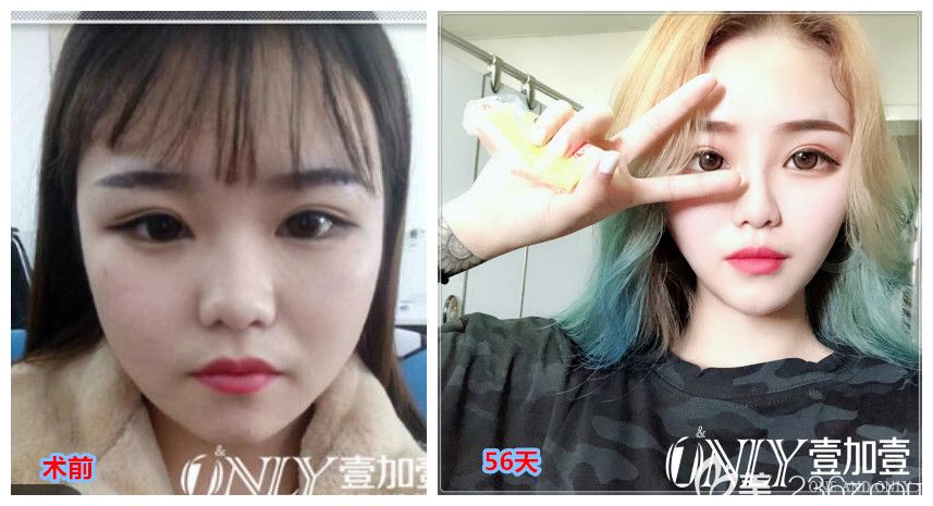 合肥壹加壹整形玻尿酸隆鼻、隆下巴以及注射了瘦脸除皱瘦脸前后效果对比图 合肥壹加壹整形玻尿酸隆鼻、隆下巴以及注射了瘦脸除皱瘦脸前后效果对比图