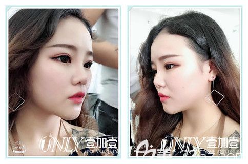 找合肥壹加壹金王做玻尿酸隆下巴+隆鼻+注射瘦脸后第2天 找合肥壹加壹金王做玻尿酸隆下巴+隆鼻+注射瘦脸后第2天