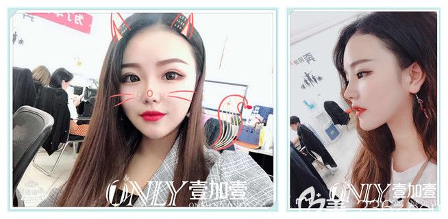 金王做隆鼻、隆下巴+瘦脸术后第7天效果图 金王做隆鼻、隆下巴+瘦脸术后第7天效果图