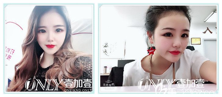 壹加壹整形注射瘦脸术后16天效果图 壹加壹整形注射瘦脸术后16天效果图