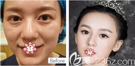 重庆郑荃丽格线雕提升效果怎么样