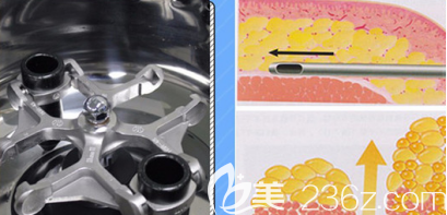 淄博美联臣自体脂肪移植吸取脂肪示意图