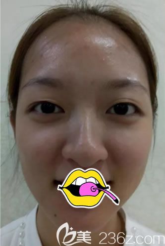 在<!--<i data=20240703-sp></i>-->做双眼皮手术前 在<!--<i data=20240703-sp></i>-->做双眼皮手术前