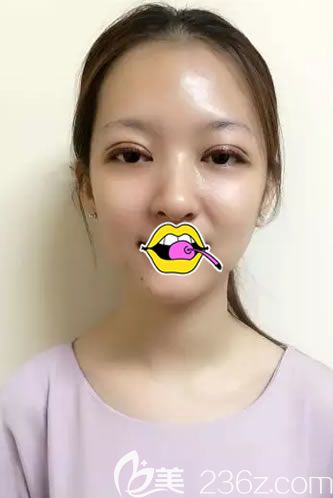 刚做完双眼皮综合手术照片 刚做完双眼皮综合手术照片