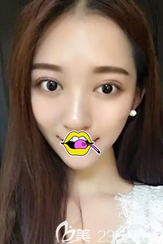 在<!--<i data=20240703-sp></i>-->做双眼皮10天恢复照 在<!--<i data=20240703-sp></i>-->做双眼皮10天恢复照