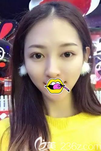 应付过年的各种party,有我找谭成林院长做的双眼皮大眼睛足矣