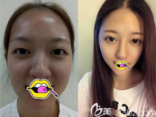 <!--<i data=20240703-sp></i>-->谭成林双眼皮案例对比图 <!--<i data=20240703-sp></i>-->谭成林双眼皮案例对比图