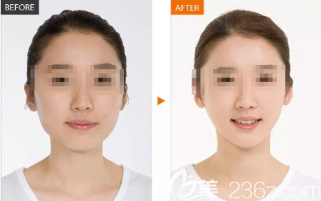 贵阳美贝尔打瘦脸效果怎么样 贵阳美贝尔打瘦脸效果怎么样