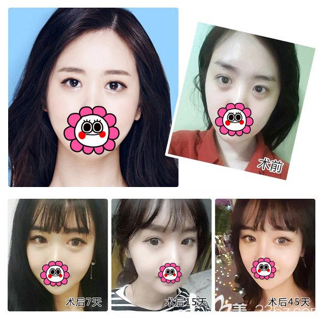 在南通维多利亚做V·纯韩无痕祛眼袋手术案例 在南通维多利亚做V·纯韩无痕祛眼袋手术案例