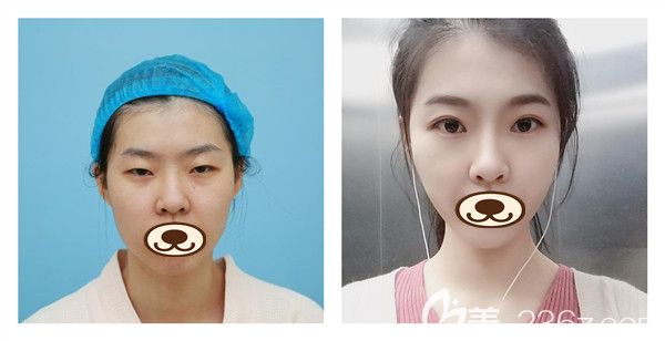 潍坊华美整形任传琦医生眼综合+假体隆鼻真实案例对比照