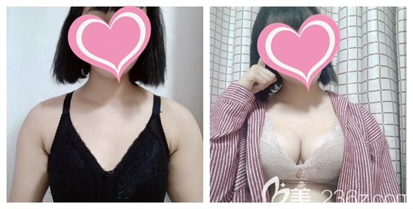 潍坊华美整形美容医院任传琦医生自体脂肪丰胸真实术后对比照