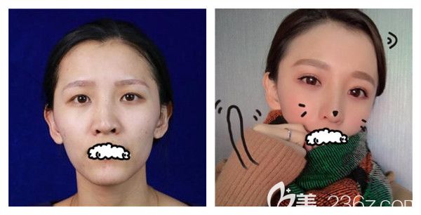 潍坊华美整形美容医院玻尿酸面部填充术后18天效果对比