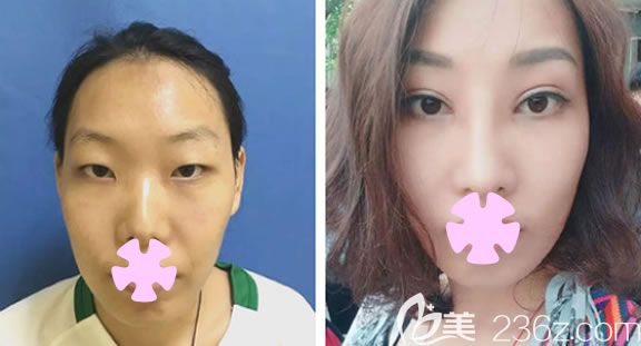 玉林时光整形全切双眼皮加开眼角术后30天恢复效果 玉林时光整形全切双眼皮加开眼角术后30天恢复效果