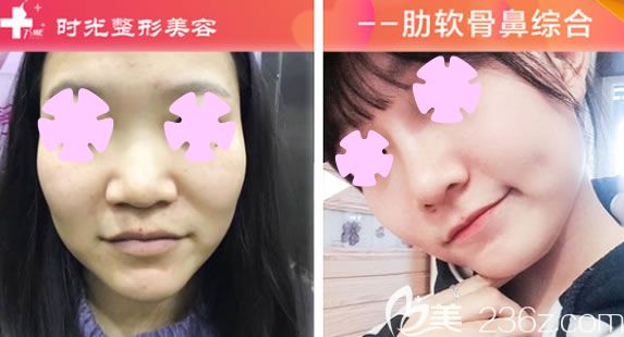 玉林时光整形鼻综合案例效果 玉林时光整形鼻综合案例效果