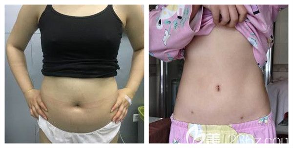 潍坊华美整形美容医院腰腹吸脂术后21天对比图