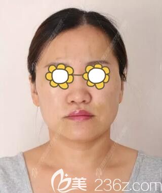 做面部埋线提升术后第三天效果