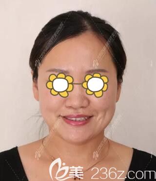 做完面部埋线提升术后半个月效果情况