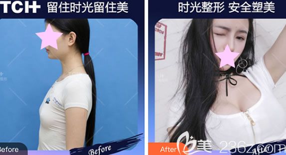 玉林时光整形曼托假体隆胸案例 玉林时光整形曼托假体隆胸案例