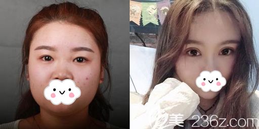 西安高一生做切开双眼皮术后恢复效果 西安高一生做切开双眼皮术后恢复效果