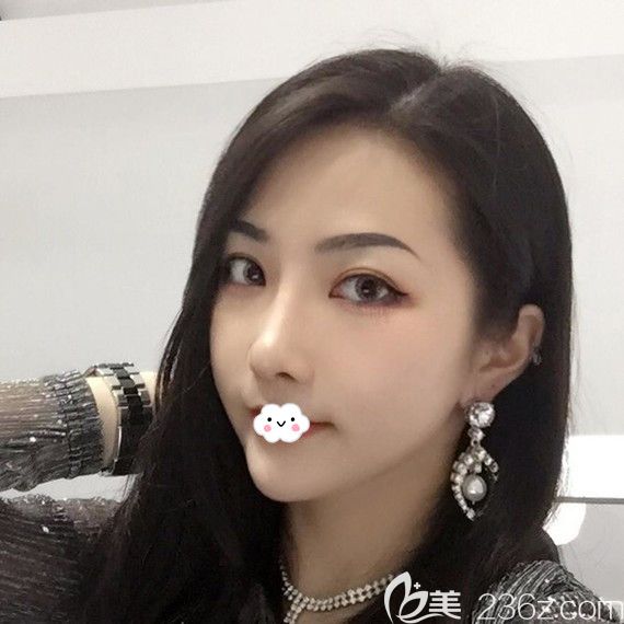 武汉美立方胡江伟割双眼皮效果好吗？案例术后照片