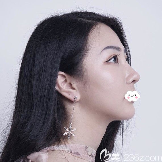 武汉美立方胡江伟隆鼻怎么样？鼻修复案例