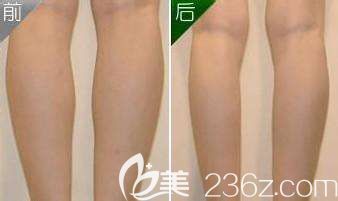 苏亚美联臣整形医院瘦小腿案例 苏亚美联臣整形医院瘦小腿案例