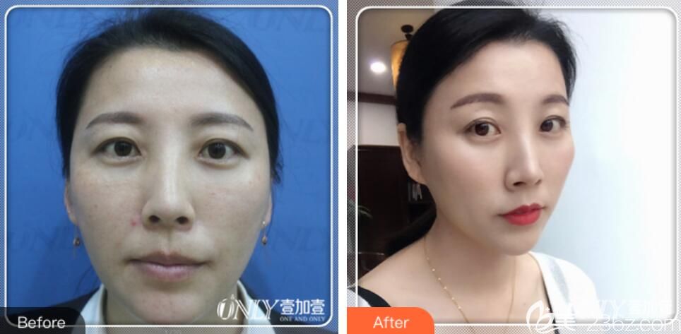 合肥壹加壹韩江稳怎么样?安多可黄金微针修复案例效果来证明 合肥壹加壹韩江稳怎么样?安多可黄金微针修复案例效果来证明