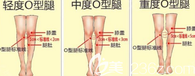 o型腿按照程度划分的图形