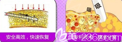 吸脂示意图