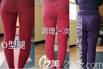 O型腿改善案例图