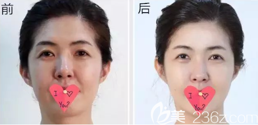 贵阳美贝尔玻尿酸面部填充前后效果 贵阳美贝尔玻尿酸面部填充前后效果