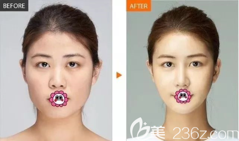 贵阳美贝尔玻尿酸加瘦脸效果对比 贵阳美贝尔玻尿酸加瘦脸效果对比