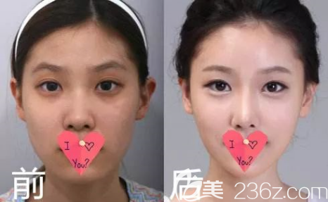 贵阳美贝尔整形新春玻尿酸低至380元起！拯救你一年的奔波和疲态！