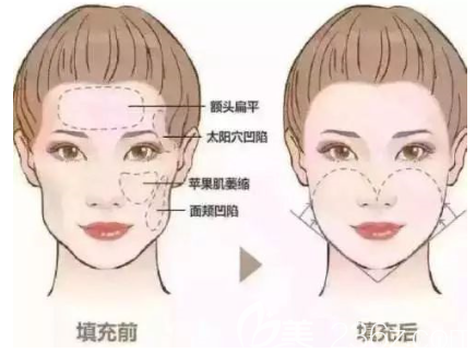 填充部位解读 填充部位解读