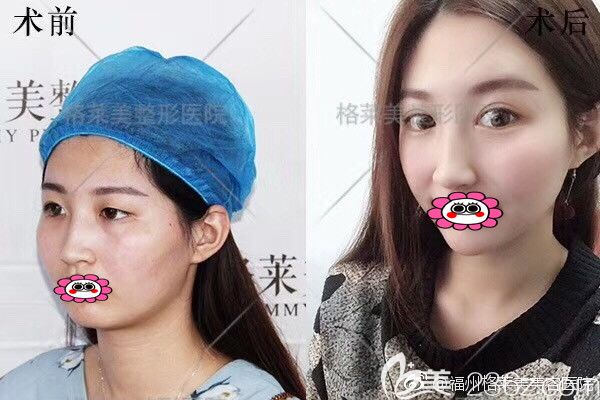 福州格莱美双眼皮对比图 福州格莱美双眼皮对比图