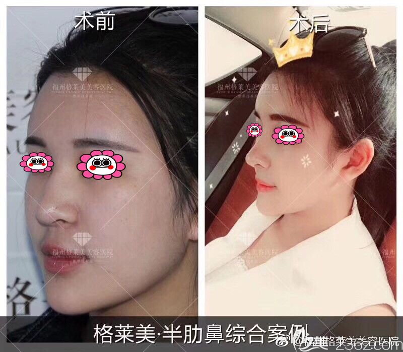 福州格莱美郑少雄隆鼻变化图 福州格莱美郑少雄隆鼻变化图