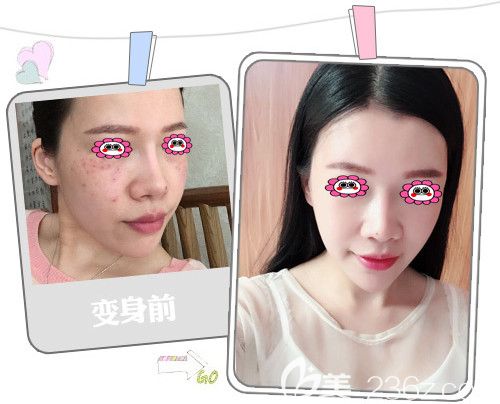 福州格莱美祛斑效果图 福州格莱美祛斑效果图