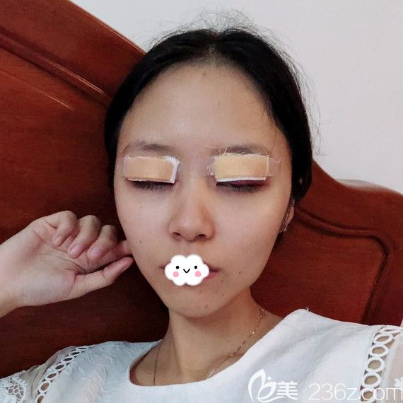 <!--<i data=20240703-sp></i>-->时光割双眼皮效果怎么样？包涛眼综合案例