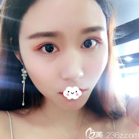 <!--<i data=20240703-sp></i>-->时光包涛双眼皮+开内眼角案例术后效果