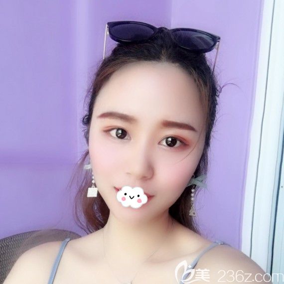 武汉双眼皮哪家医院好？<!--<i data=20240703-sp></i>-->包涛眼综合案例