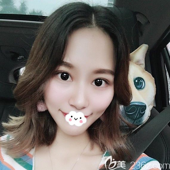 时光整形医院割双眼皮效果好吗?找包涛做眼综合术后2月怡然成为美丽公举