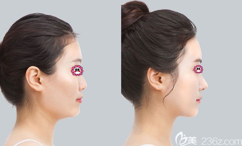 太原华美隆鼻对比图 太原华美隆鼻对比图