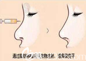 自体脂肪注射隆鼻不好塑形