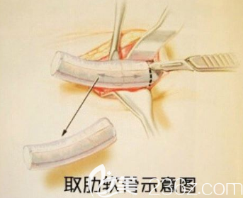 软骨隆鼻两年内会发生吸收