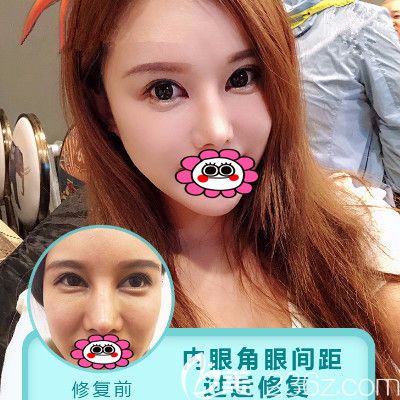 于智宏双眼皮失败修复效果图 于智宏双眼皮失败修复效果图