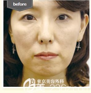 木村幸志伊做埋线提拉前 木村幸志伊做埋线提拉前