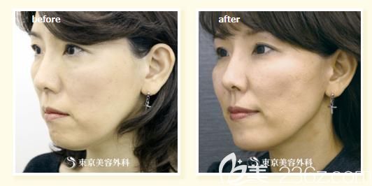 木村幸志伊做蛋白线提拉半侧面前后对比 木村幸志伊做蛋白线提拉半侧面前后对比