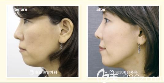 木村幸志伊做蛋白线提拉侧面前后对比 木村幸志伊做蛋白线提拉侧面前后对比