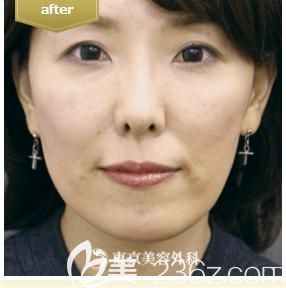 四十岁的我到东京整形外科医院面诊木村幸志伊做蛋白线面部提升后，逆转年龄重现少女脸